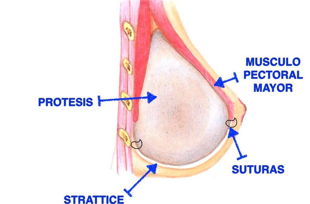 strattice reconstruccion mamas