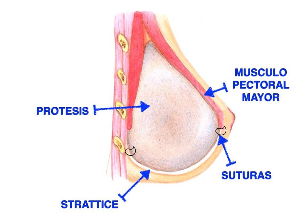strattice reconstruccion mamas