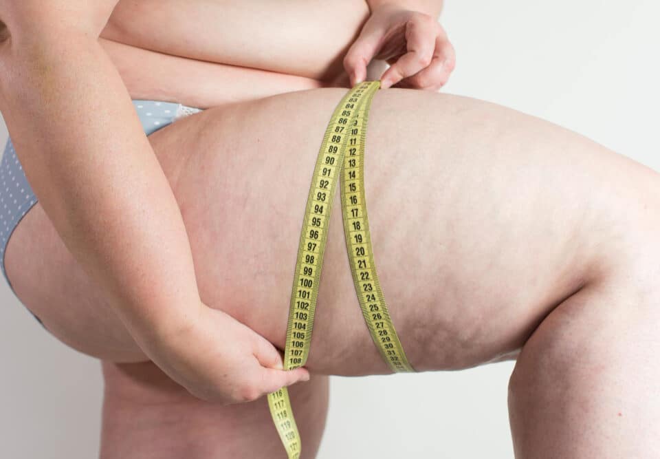 liposucción lipedema