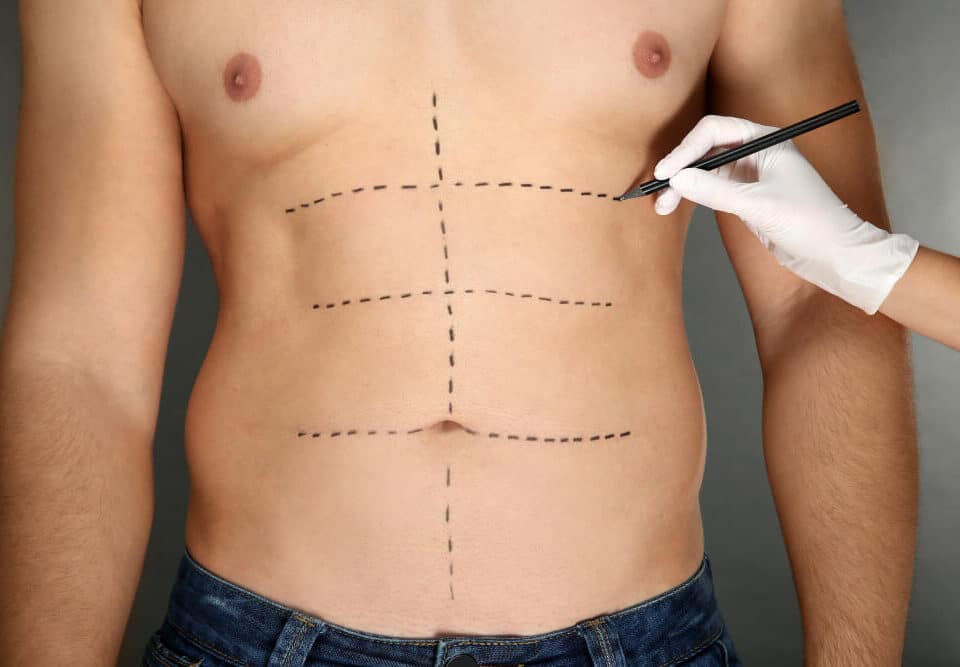 beneficios abdominoplastia