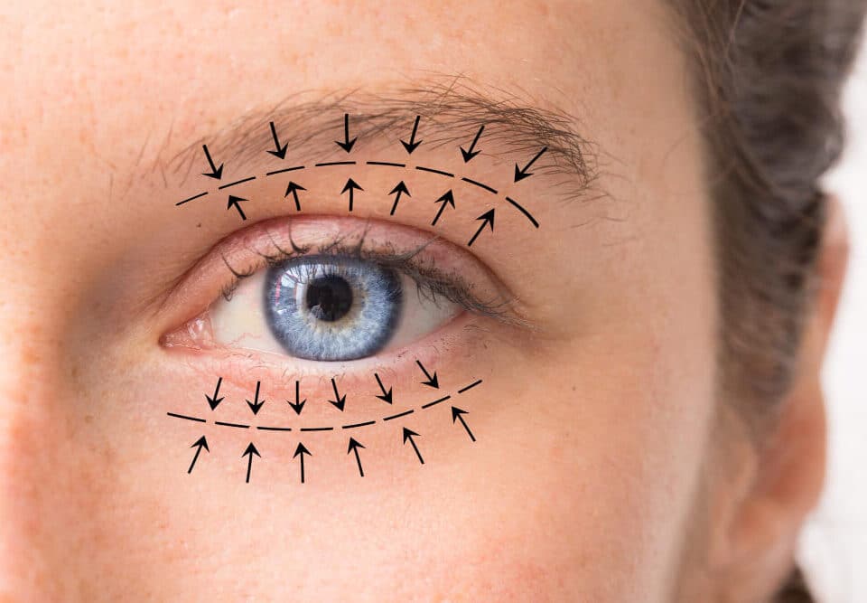 blefaroplastia